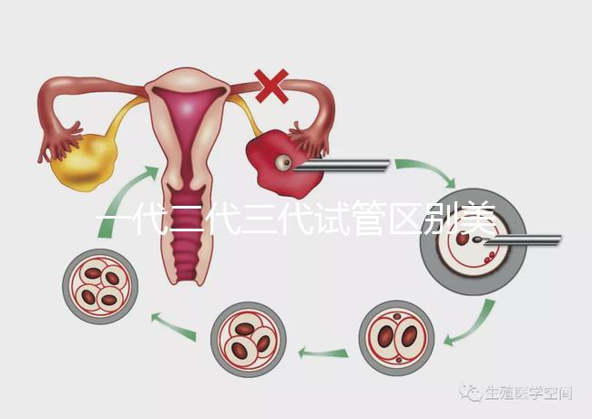 一代二代三代試管區(qū)別美琳達(dá)（一代二代三代試管區(qū)別及價(jià)格）