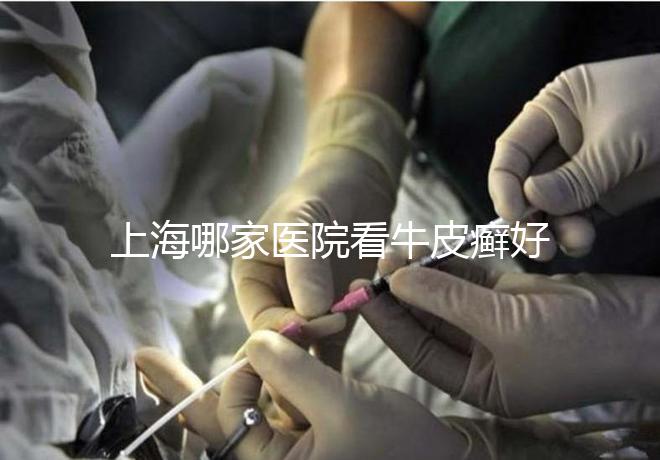 上海哪家醫(yī)院看牛皮癬好(上海治銀屑病最好的醫(yī)院)