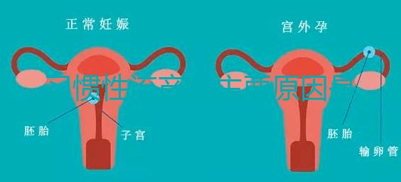 習慣性流產的主要原因是什么？