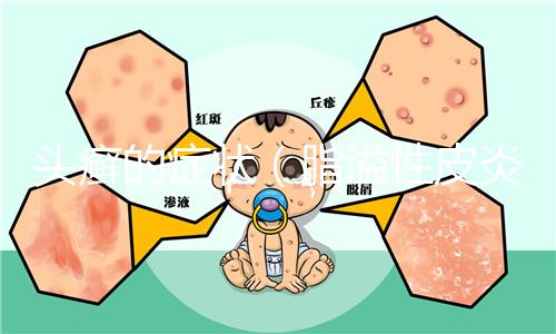 頭癬的癥狀（脂溢性皮炎和頭癬區(qū)別）