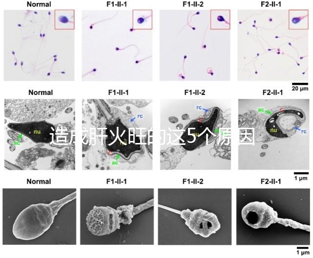 造成肝火旺的這5個原因,你都知道嗎?