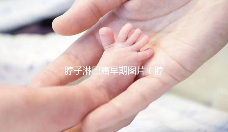 脖子淋巴癌早期圖片(脖子有結節的圖片)