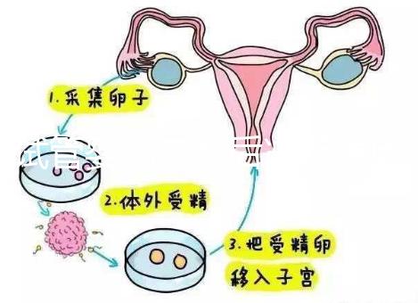 試管嬰兒二超后減藥原因已找到，對胎兒沒影響別瞎擔心